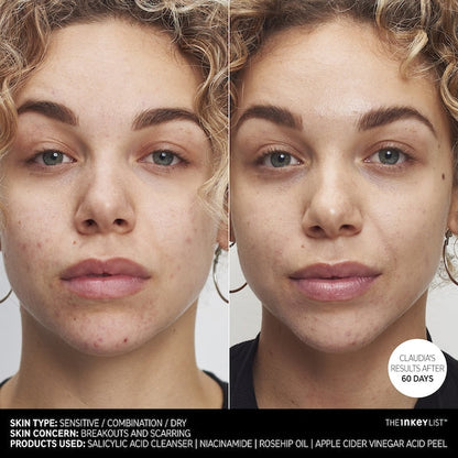 Apple Cider Vinegar Acid Peel